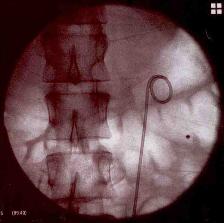 Cateter Ureteral Duplo J 