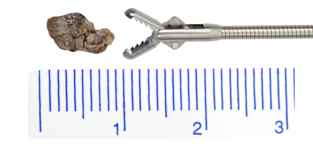 Pinça 7Fr Semirrígida 370mm para Retirada de Corpo Estranho, Duplo J e Biopsia